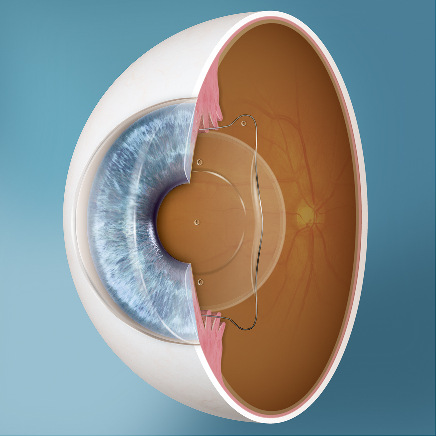 EVO ICL Linse im Auge
