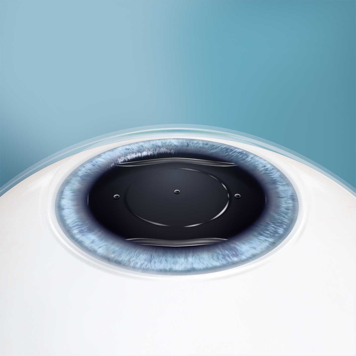 Schritt 3 – Positionierung der Linse hinter der Iris